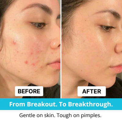 Hydrocolloid Pimple Tape